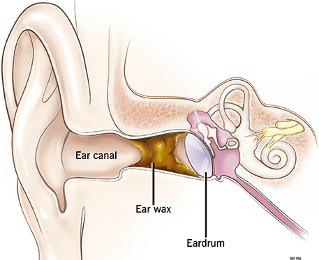Tinnitus: Gejala, Penyebab, dan Cara Penyembuhan yang Efektif