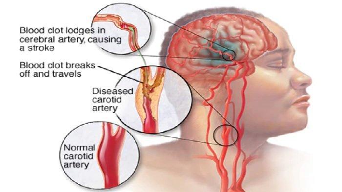 Tinnitus: Gejala, Penyebab, dan Cara Penyembuhan yang Efektif