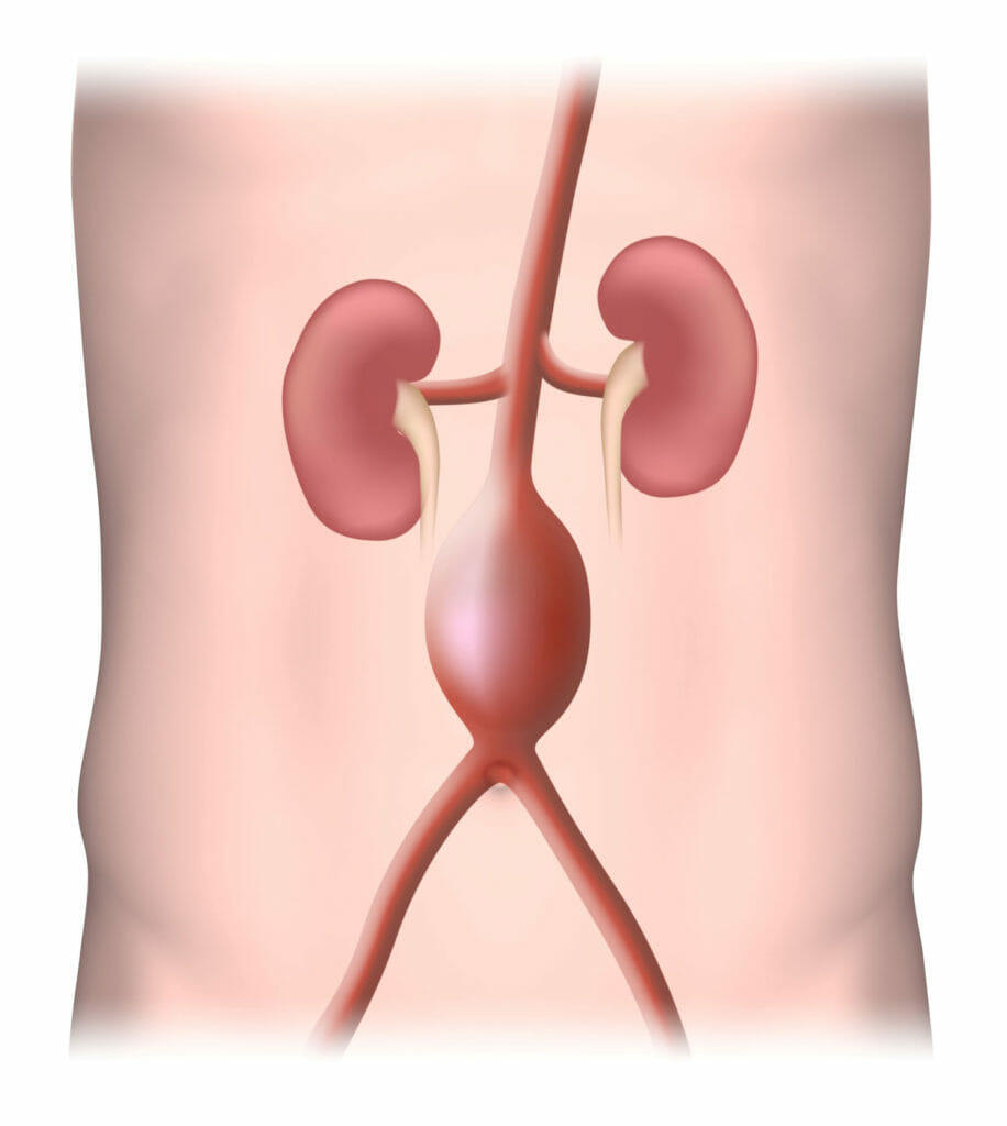 Aneurisma Aorta Perut, Penyebab Kematian Mendadak