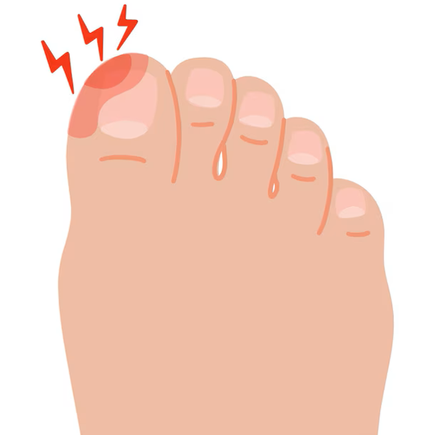Ingrown Toenails: Kenali Penyebab dan Cara Mencegahnya!