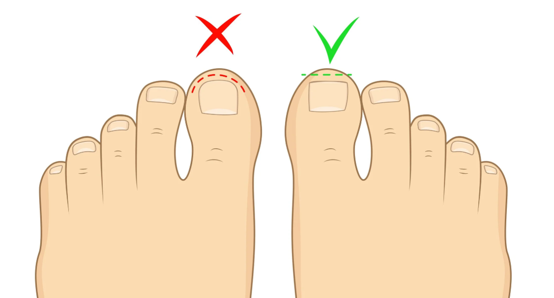 Ingrown Toenails: Kenali Penyebab dan Cara Mencegahnya!