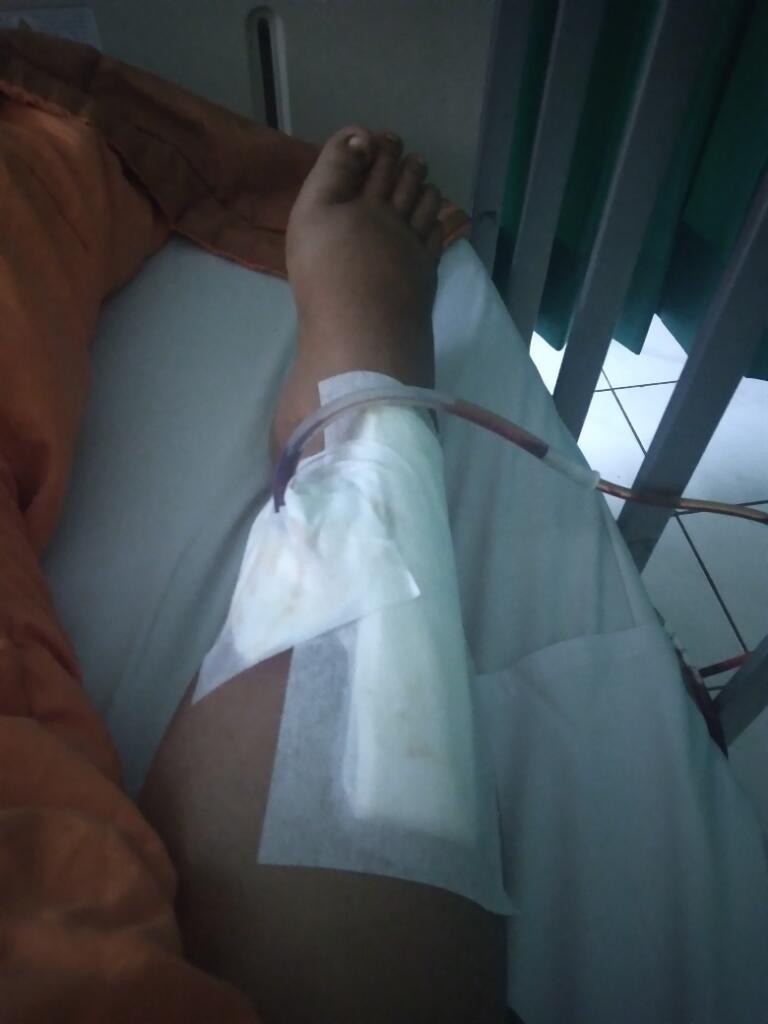 Pengalaman marywiguna13 Menjalani Operasi Lepas Pen Tulang #JustShare