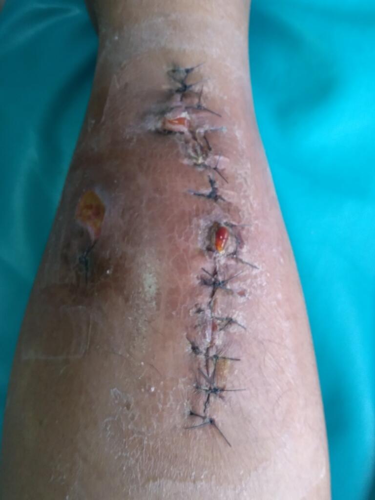 Pengalaman marywiguna13 Menjalani Operasi Lepas Pen Tulang #JustShare