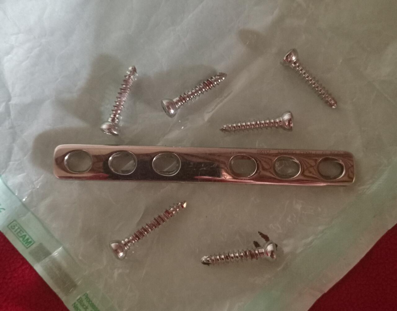 Pengalaman marywiguna13 Menjalani Operasi Lepas Pen Tulang #JustShare