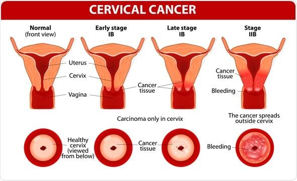 Jangan Tunggu Terlambat, Vaksin HPV Selagi Masih Muda!!