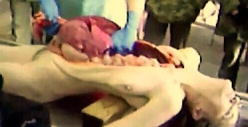 Autopsy Cwe Cakep..Meninggal habis lari Marathon