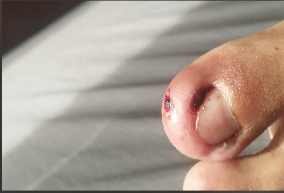 Pengalaman Sembuh dari Cantengan Kronis &amp; Granuloma