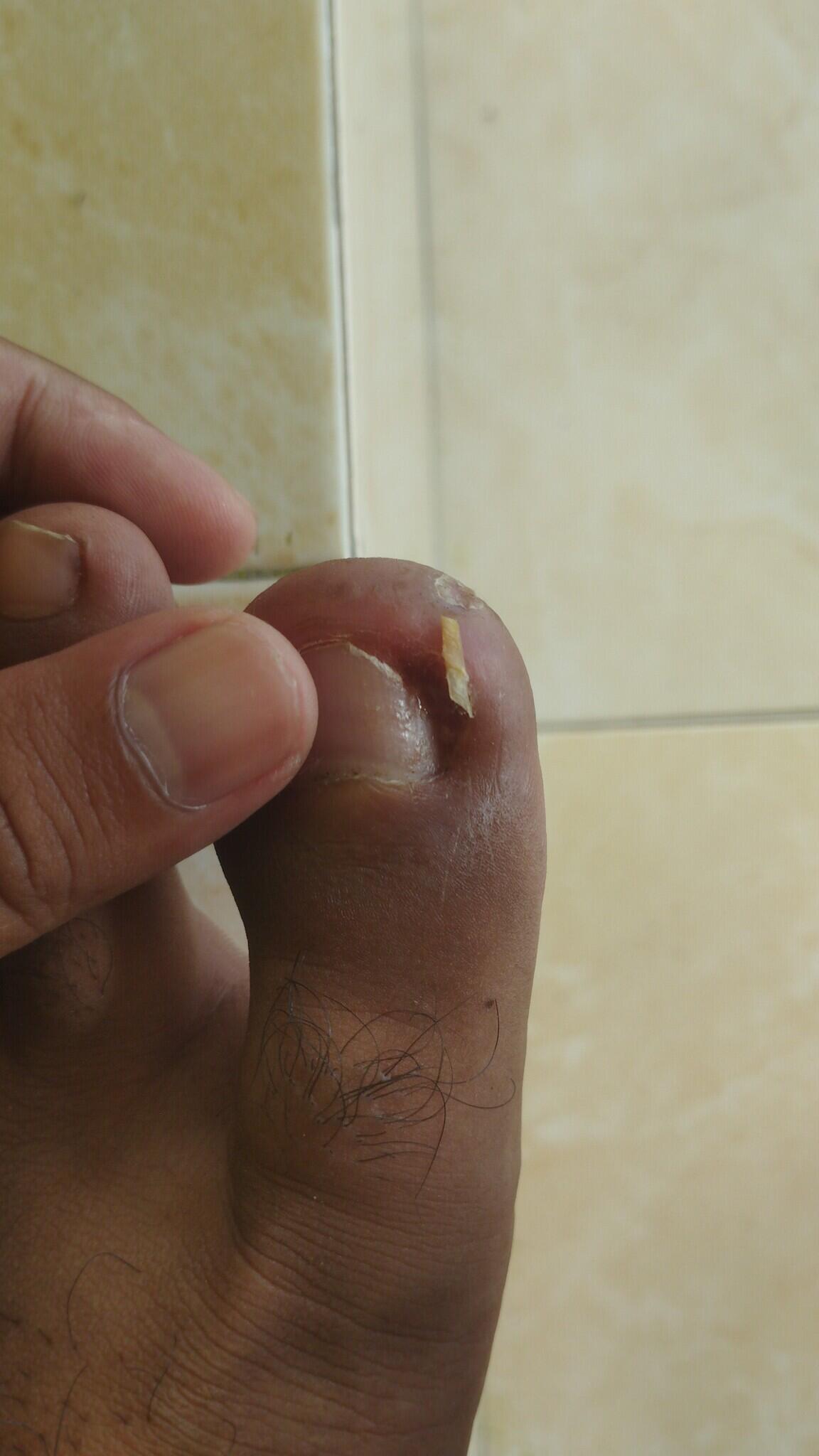 Pengalaman Sembuh dari Cantengan Kronis &amp; Granuloma