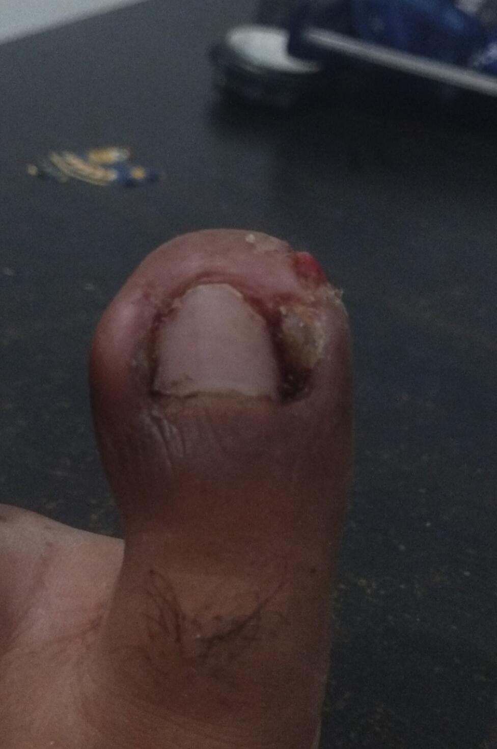 Pengalaman Sembuh dari Cantengan Kronis &amp; Granuloma