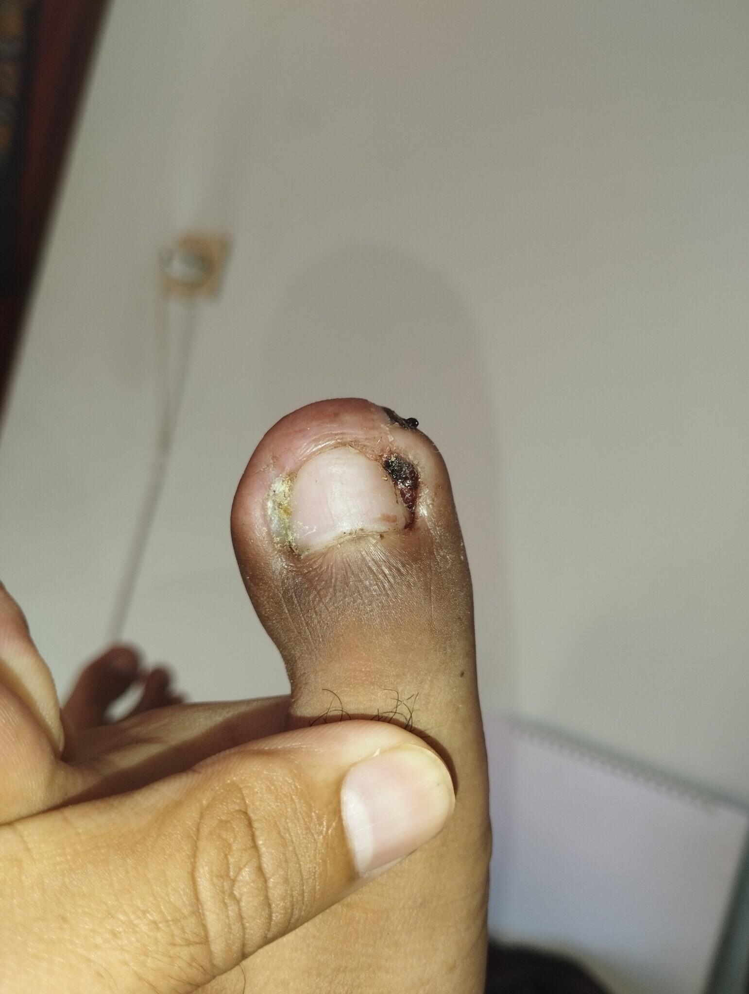 Pengalaman Sembuh dari Cantengan Kronis &amp; Granuloma