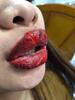 Pakai Tattoo Lip KW, Bibir Wanita ini Alami Infeksi sampai Membengkak Parah