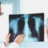 7 Gejala Sinusitis Awal Ini Gak Boleh Disepelekan, Jangan Sampai Parah