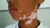 Vitiligo pada hari kematian bintang pop Michael Jackson