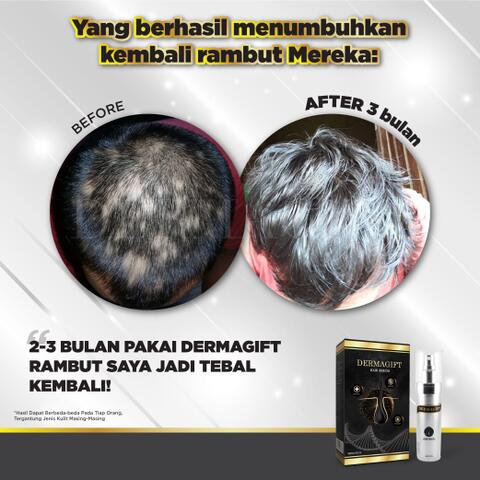 Dermagift Penumbuh Rambut Cegah Botak dan Kerontokan