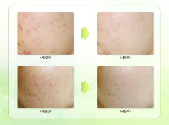 Bintik Hitam ?! Big No No !!! Solusinya Its Skin_KOREA BRAND