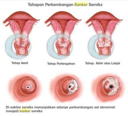 Terjual Cara Tepat Menyembuhkan Kanker Rahim Dengan Sun Hope Kaskus