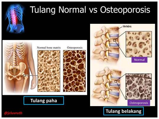 Cara Pencegahan Dini Osteoporosis
