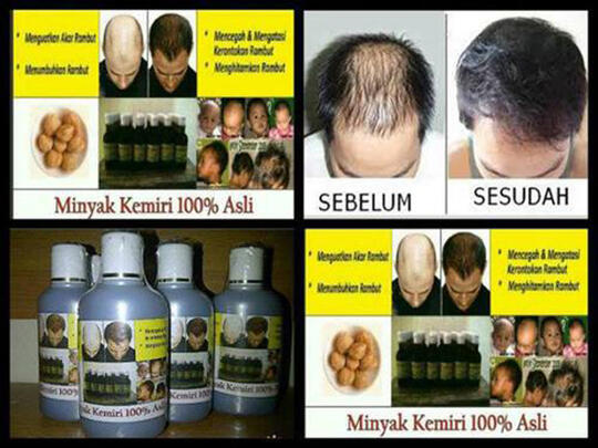 Terjual Minyak Kemiri Asli Atasi Kebotakan Rambut Rontok Dan Menebalkan Rambut Kaskus