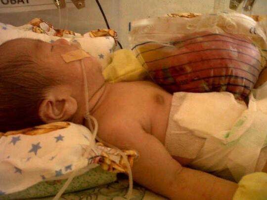 Penyakit Gastroschisis Bayi Petani Ini Butuh Bantuan Kaskus