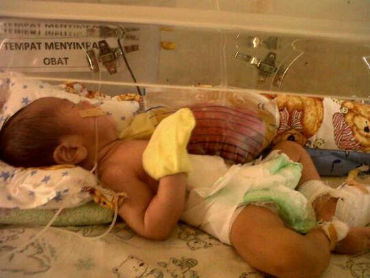 Penyakit Gastroschisis Bayi Petani Ini Butuh Bantuan Kaskus