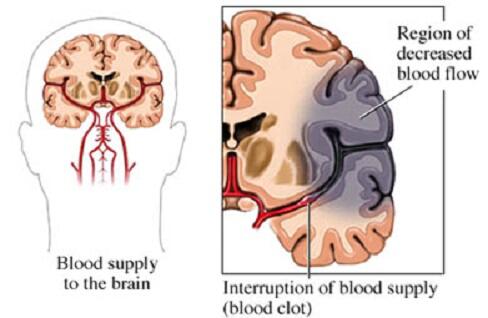 Sindrom Super Langka : Foreign Accent Syndrome !!! Cekidot Gan !!!