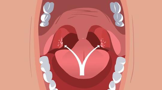 Apa Itu Tonsil Stone Nih Cara Menghilangkannya Kaskus