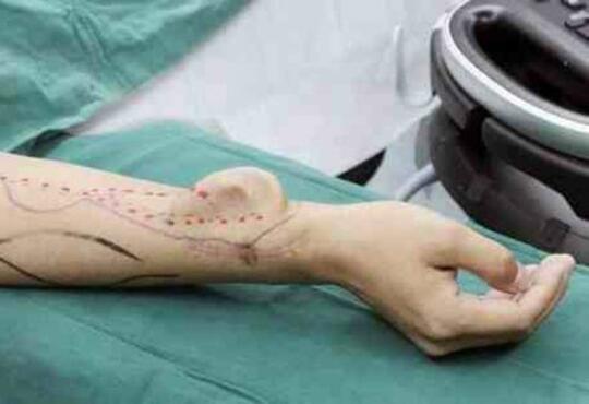 Dokter di China Sukses Tumbuhkan Telinga di Tangan Pasien