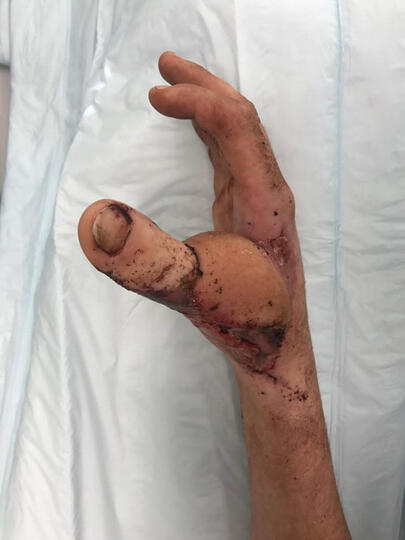 Kasihan... Karena Kecelakaan, Jempol Tangan Agan Ini Diganti Jempol Kaki