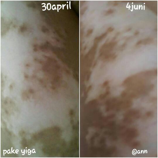 Cewek Ane Kena Vitiligo Need Solusi Dan Penyembuhannya Apa Page 2 Kaskus