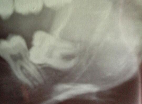 [SHARE] Pengalaman Cabut Gigi Geraham Bungsu