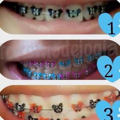 Memakai Behel Itu Alay? Yuk Ikuti Tips Berikut agar Behel tak Menjadi Perusak