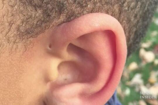 Punya Lubang Kecil Di Atas Telinga?? Ini Alasannya