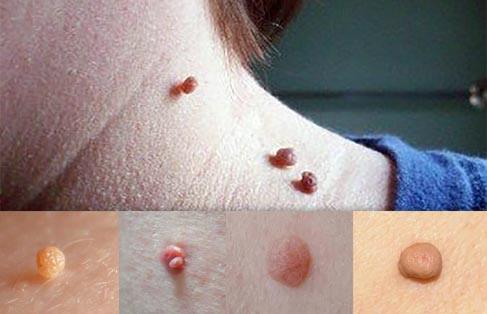 Mengenal Skin Tag, Benjolan Selain Tahi Lalat yang Tidak Berbahaya?
