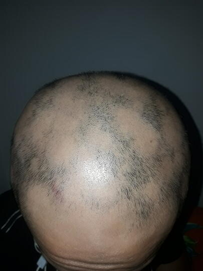 Alopecia Areata Kaskus