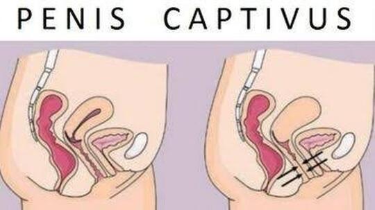 Viral Pasangan Meninggal Gancet, Bukan Mitos Ternyata Penyebabnya ini Gan!
