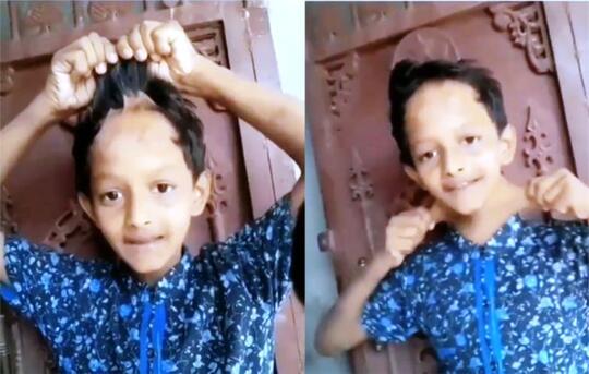 Mengerikan! Kulit Bocah ini Bisa Melar Seperti Monkey D. Luffy di Anime One Piece
