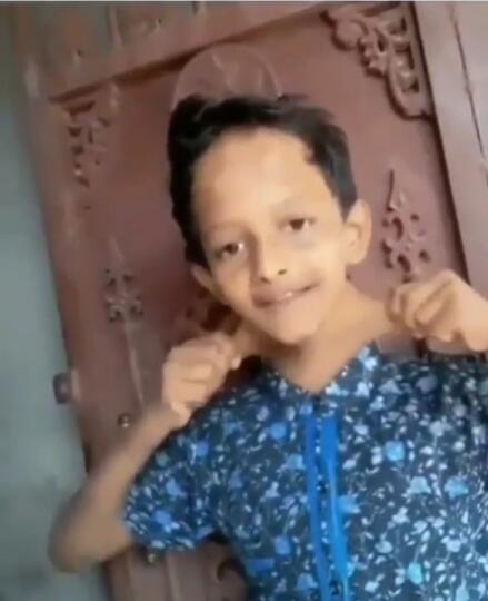 Mengerikan! Kulit Bocah ini Bisa Melar Seperti Monkey D. Luffy di Anime One Piece