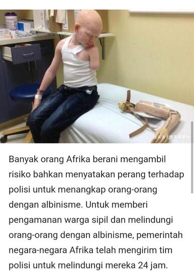 Misteri Albinisme Yang Diburu Dan Dihargai Paling Mahal Darahnya, Benarkah Demikian?