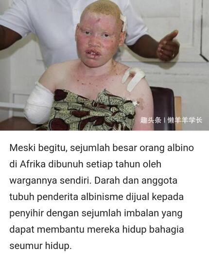 Misteri Albinisme Yang Diburu Dan Dihargai Paling Mahal Darahnya, Benarkah Demikian?