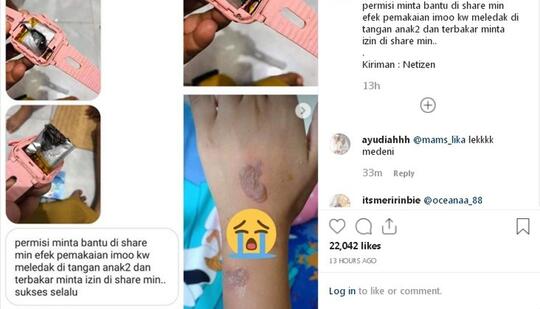 Viral Meledaknya Smartwatch Harga Murah di Tangan Anak-anak Sampai Melepuh