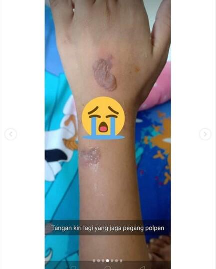 Viral Meledaknya Smartwatch Harga Murah di Tangan Anak-anak Sampai Melepuh