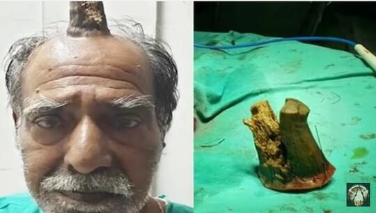 Kejadian Langka Dari India, Pria Ini Punya Tanduk Yang Terus Tumbuh Diatas Kepala