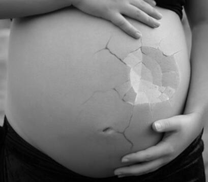 Stretch Mark Momok Pasca Melahirkan, Jangan Khawatir Sista