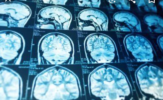 Apakah Itu Prosopagnosia, dan Bagaimana Cara Mengatasinya?