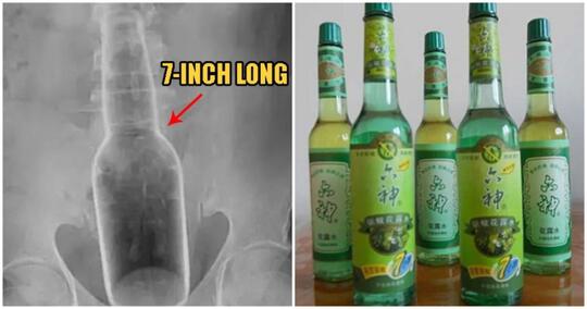 Pria Ini Kesakitan Akibat Secara Tak Sengaja Botol Sepanjang 7 Inci Masuk Ke Duburnya