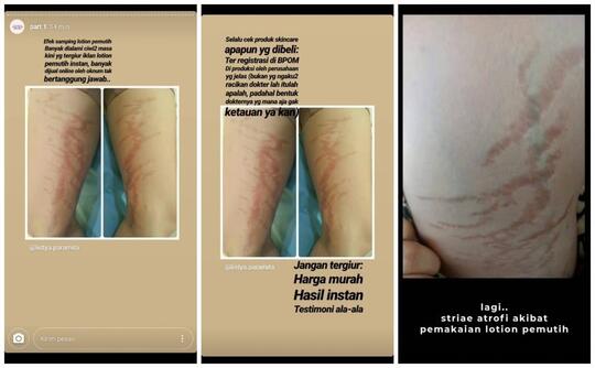 Akibat Krim Pemutih Abal-abal yang Dibeli Online, Wanita Ini Alami Hal Mengerikan!