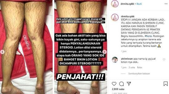 Akibat Krim Pemutih Abal-abal yang Dibeli Online, Wanita Ini Alami Hal Mengerikan!