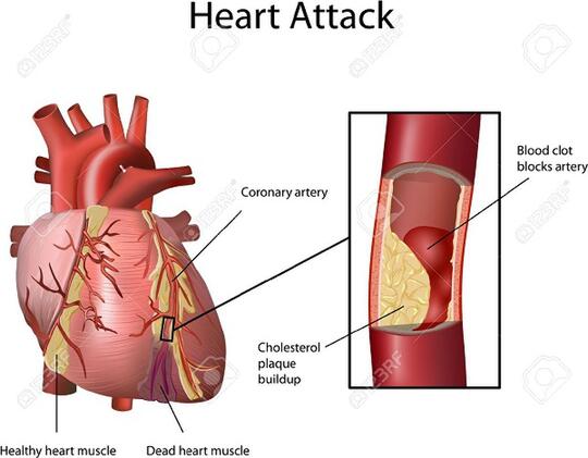 Pahami Sudden Cardiac Arrest, Penyebab Kematian Ashraf Sinclair, Suami BCL.