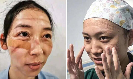 Potret Wajah Perawat Virus Corona China, Wajah Lebam Membiru karena Masker