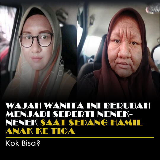 Wajah Wanita Ini Berubah Menjadi Seperti Nenek-Nenek Karena Hamil Anak Ketiga